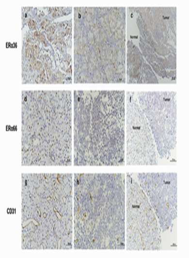 Expression patterns of ERα66 and its novel variant isoform ERα36 in lactotroph pituitary adenomas and associations with clinicop
